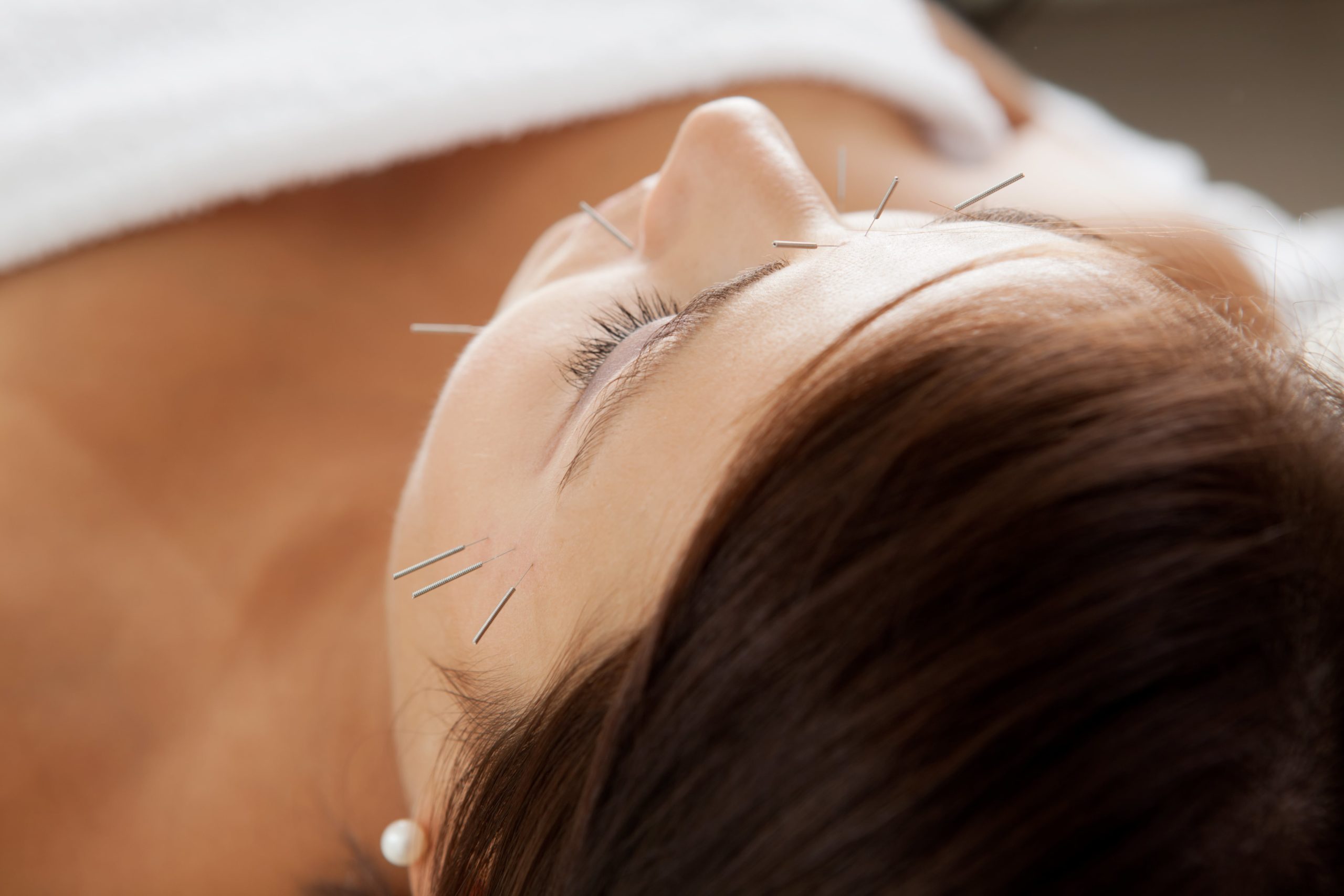 Aculifting Lifting par acupuncture