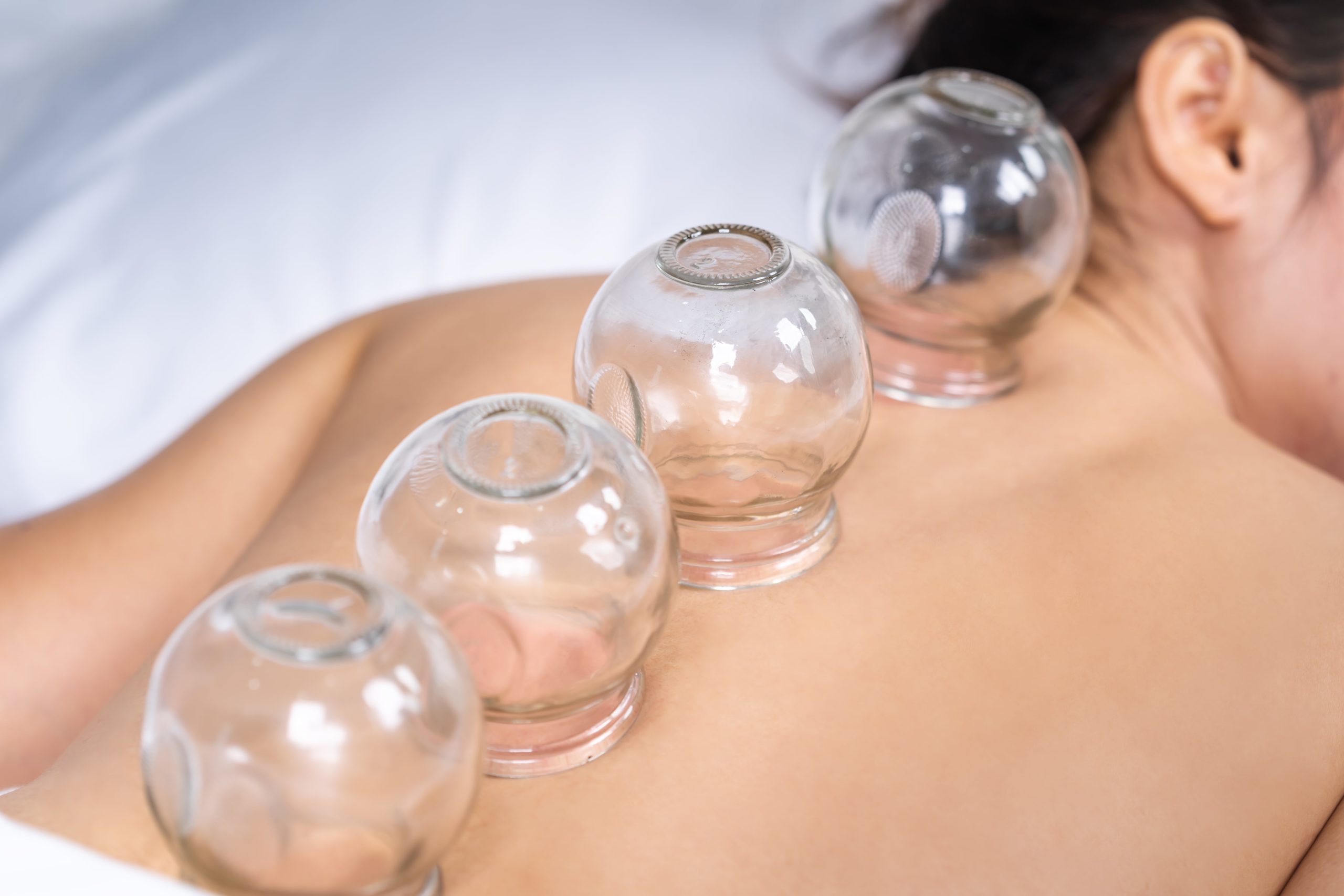 Ventouses Cupping Therapy Médecine Chinoise